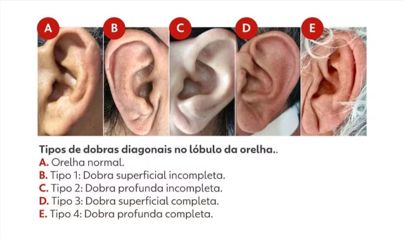 Tipos de dobras diagonais no lóbulo da orelha, com cinco exemplos visuais.