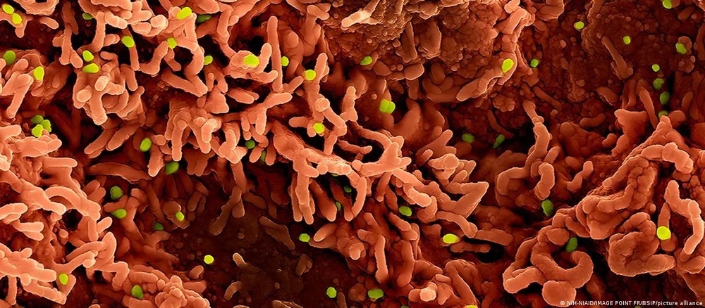 Imagem de microscopia eletrônica de vírus (verde) infectando células humanas (vermelho-amarronzado).