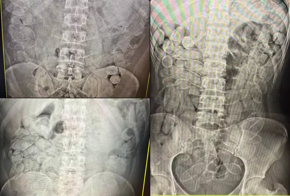 Quatro imagens de raio-X do abdômen mostrando múltiplas moedas dentro do trato gastrointestinal.